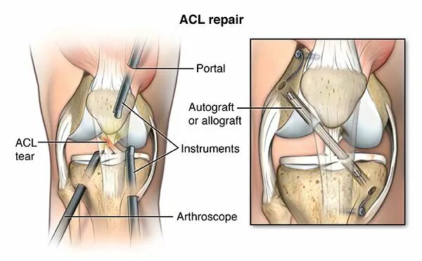 Acl что это. Разрыв передней крестообразной связки (ACL. ACL колено связки коленного.