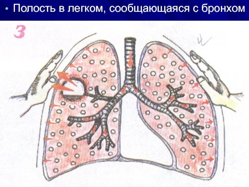 Образование полостей в легких