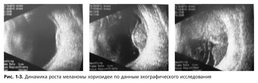 узи меланомы. методы диагностики меланомы хориоидеи:. узи меланомы.