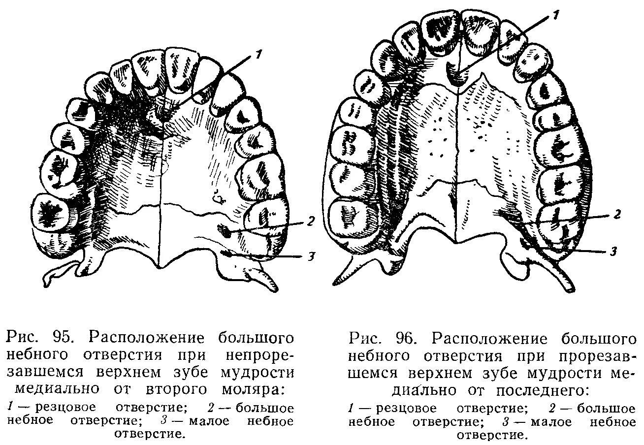 Резцовое отверстие небного. Резцовый шов на верхней челюсти. Анестезия у резцового отверстия. Анестезия у большого резцового отверстия. Отдельный отверстие