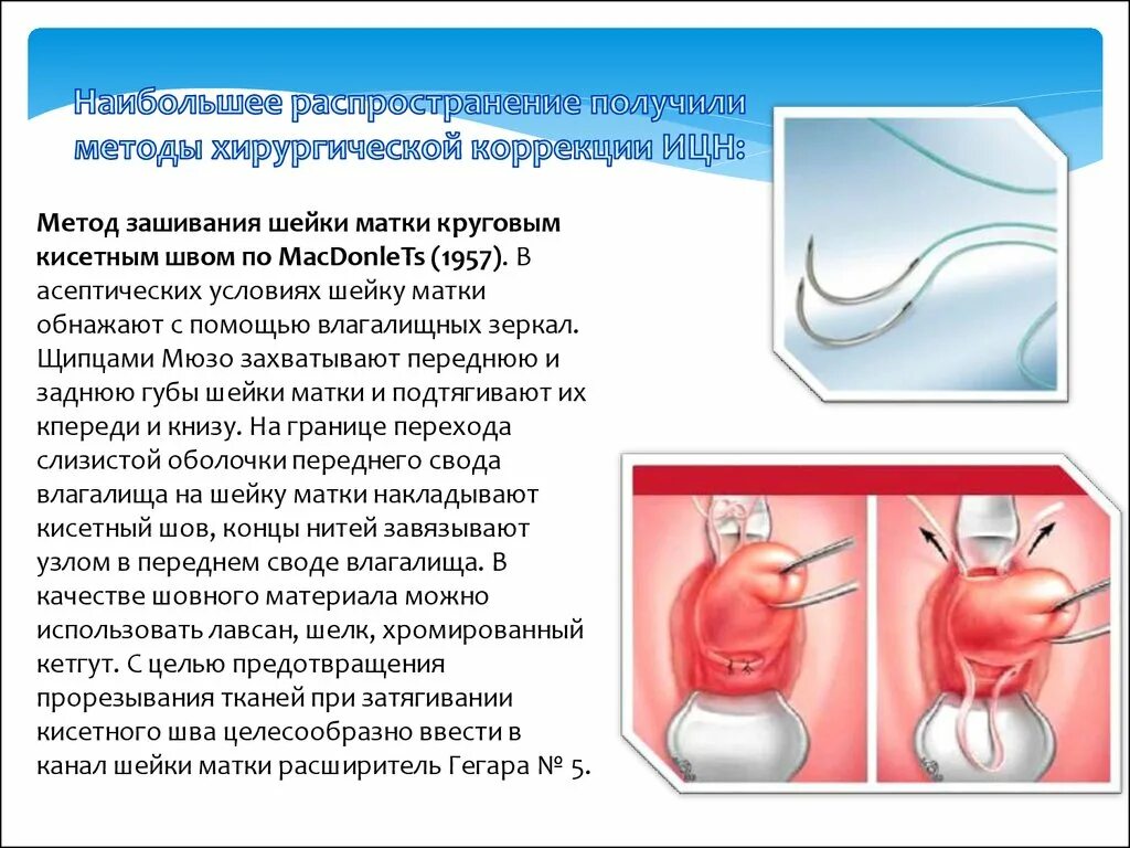 Истмико-цервикальная недостаточность — короткая шейка матки);. Хирургическая коррекция ИЦН. Методы хирургической коррекции ИЦН. Швы при ицн