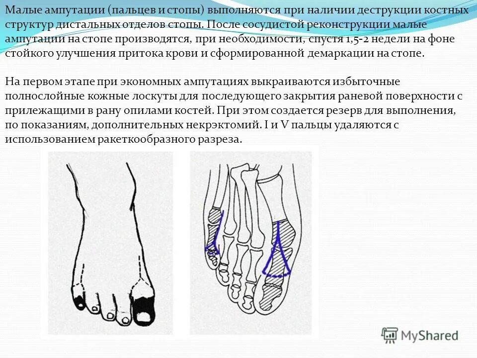 Ампутация диагноз