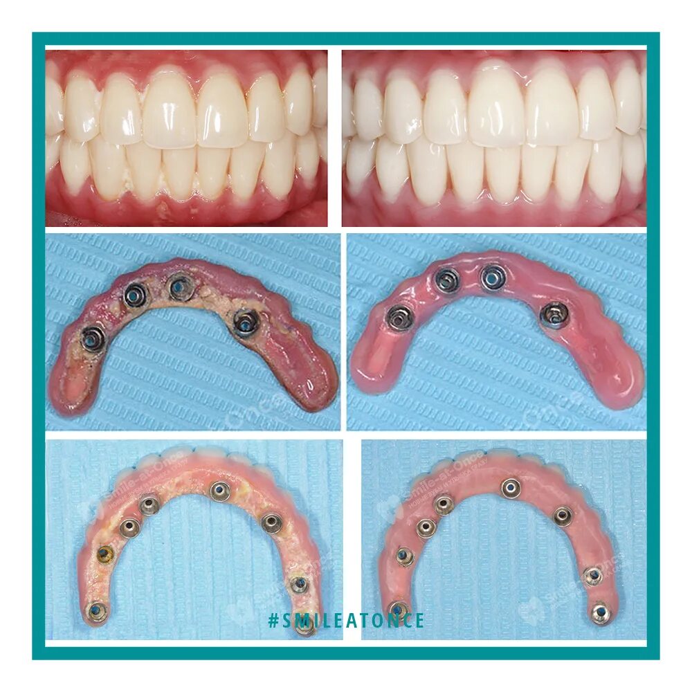 Зубные протезы на имплантах. Несъемные зубные протезы. Имплантация sup aznona com