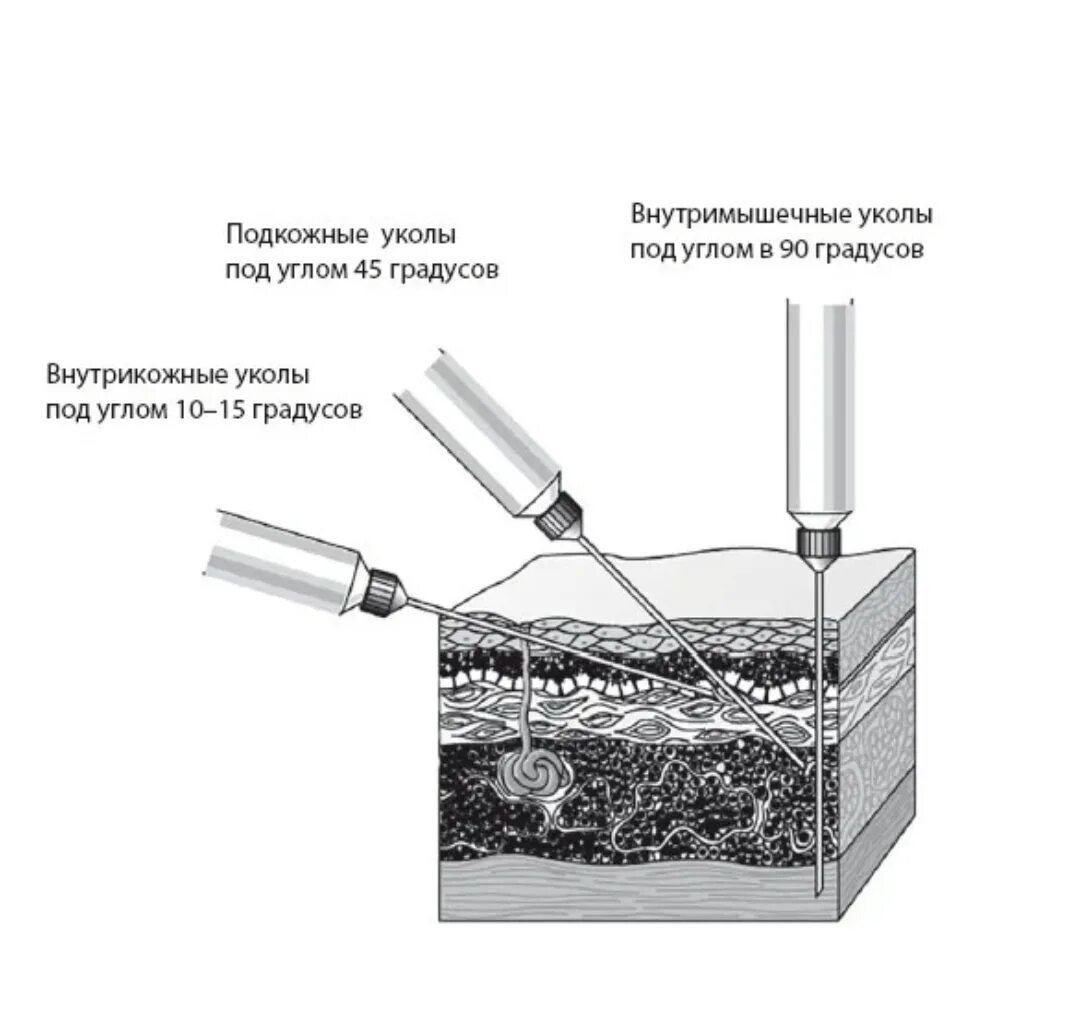 Угол введения иглы при внутрикожной инъекции. Подкожная инъекция срез иглы. Внутрикожная инъекция глубина введения иглы. Угол введения при подкожной инъекции.