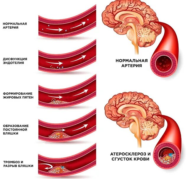 Клиника атеросклероза церебральных артерий. Атеросклероз церебральных артерий симптомы. Атеросклеротическое поражение сосудов головного мозга. Атеросклероз артерий основания головного мозга. Закупорка головных сосудов