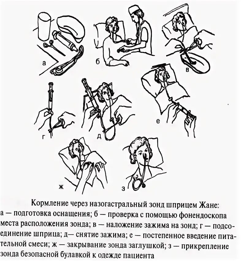 Кормление тяжелобольного через зонд алгоритм. Питание пациента через назогастральный зонд алгоритм. кормление через назогастральный зонд. кормление тяжелобольного через назогастральный зонд алгоритм. кормление через назогастральный зонд алгоритм сестринское дело.