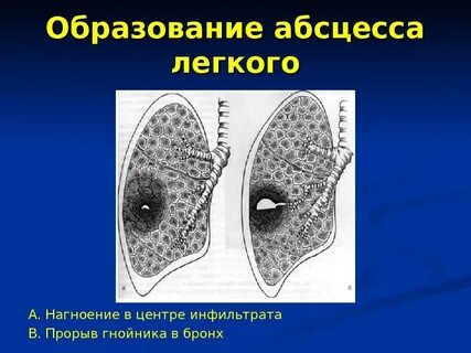 Острый гнойный абсцесс