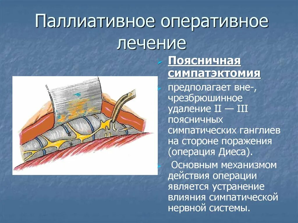 Симпатэктомия цена. Поясничная симпатэктомия ход операции. Операция симпатэктомия. Периартериальная симпатэктомия. Эндоскопическая торакальная симпатэктомия.