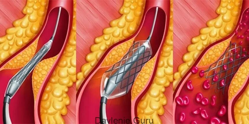Чистка тромба. Атеросклероз сосудов сердца стентирование. Атеросклероз сосудов стент. Коронарное стентирование сосудов сердца. Баллонная ангиопластика коронарных артерий.