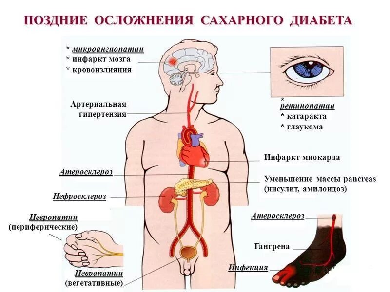 Осложнения сахарного диабета 2 типа. Осложнения при сахарном диабете 1 типа. Осложнения СД 1 типа и 2 типа. Осложнения от сахарного диабета 1 типа. Осложнения при второй