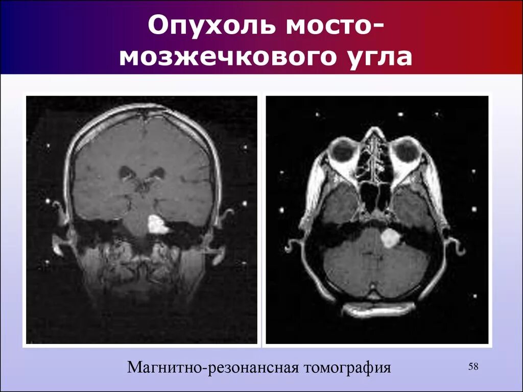Мрт головного мозга мосто мозжечкового угла. Невринома мосто-мозжечкового угла кт. опухоль.моста моздечкового угла. опухоль в мостомозжечковом углу.