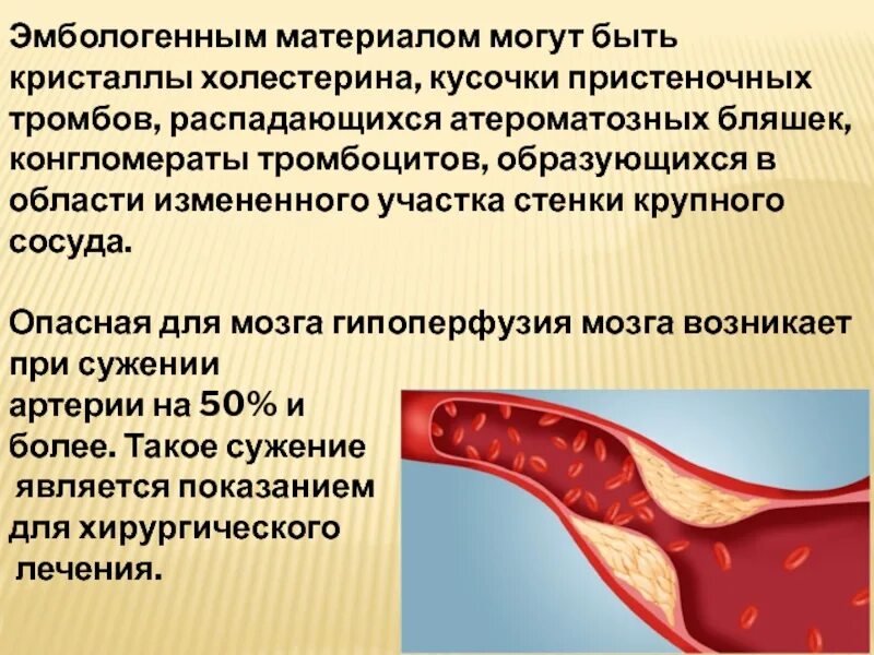 Конгломерат тромбоцитов. Стенки крупных сосудов. Как проверить сосуды на тромбы и холестериновые