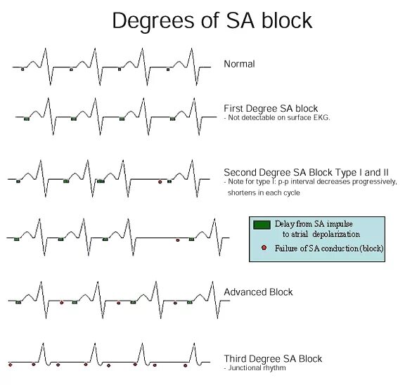 Class block block type. Sa block. sinoatrial block. sa block ecg. sa node block.