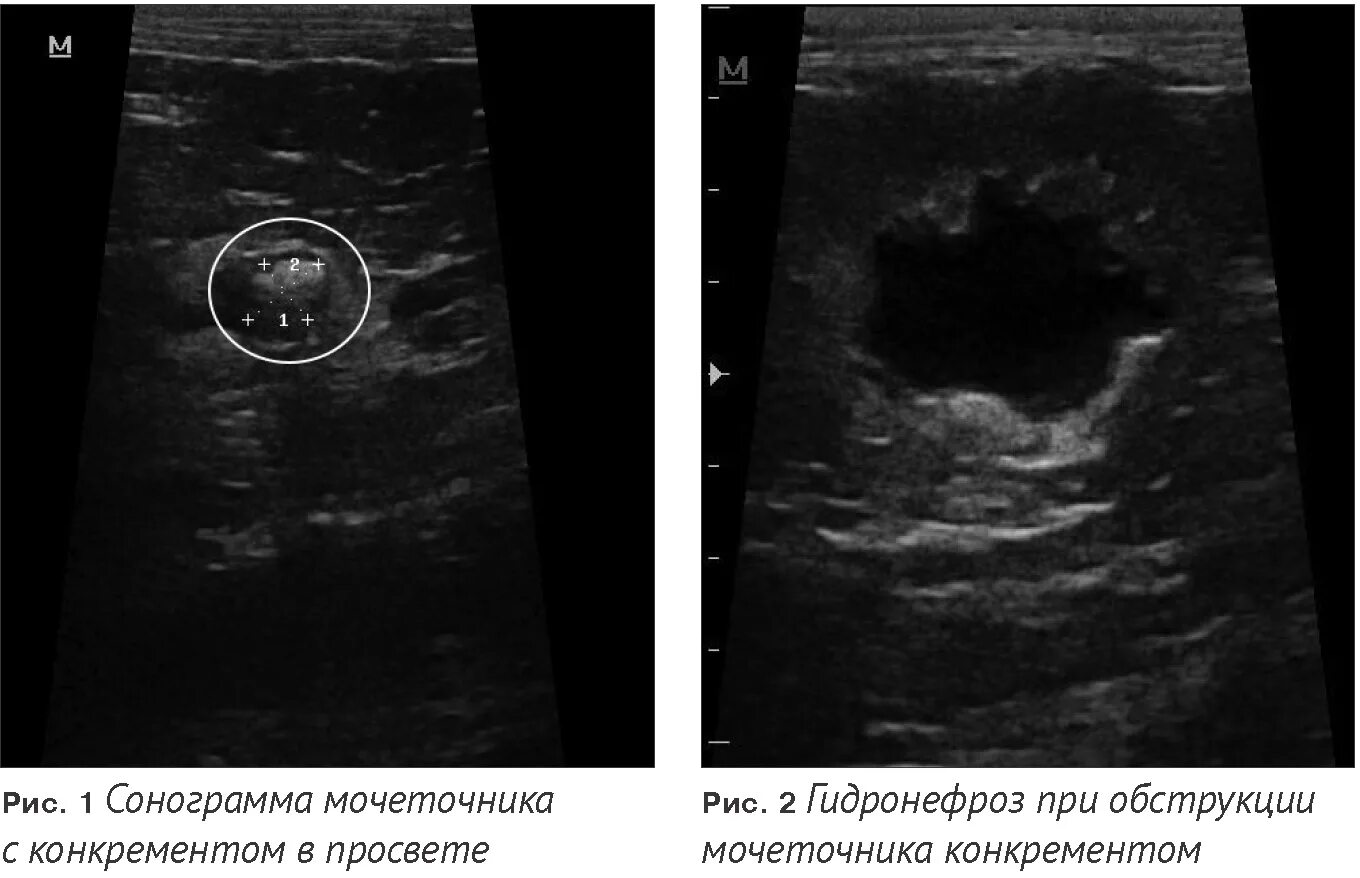 Обструкция мочеточника. Стент мочеточника эхограмма. Эктопия мочеточника у кота. Стентирование мочеточника на УЗИ.