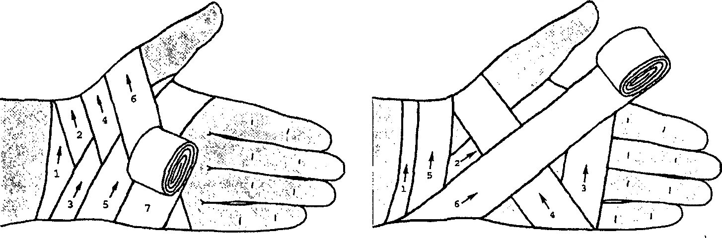 Техника наложения повязки на кисть. Перевязка запястья эластичным бинтом. Колосовидная повязка на кисть. Повязка на лучезапястный сустав десмургия. Крестообразная повязка на лучезапястный сустав алгоритм.