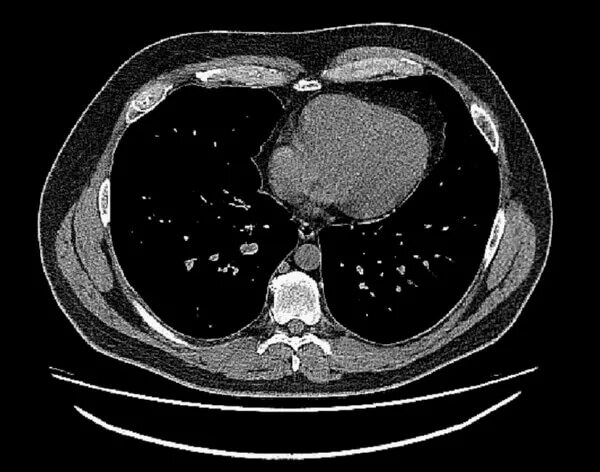 Кт грудной клетки метастазы.