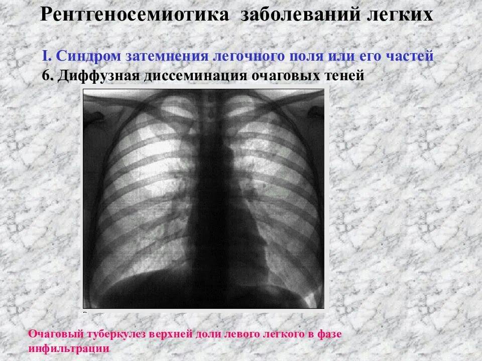 Рентгеносемиотика заболеваний легких. Лучевые синдромы заболевание легких. Очаговая тень в легочном поле. Синдром затемнения легочного поля. Тени в верхней доле легкого