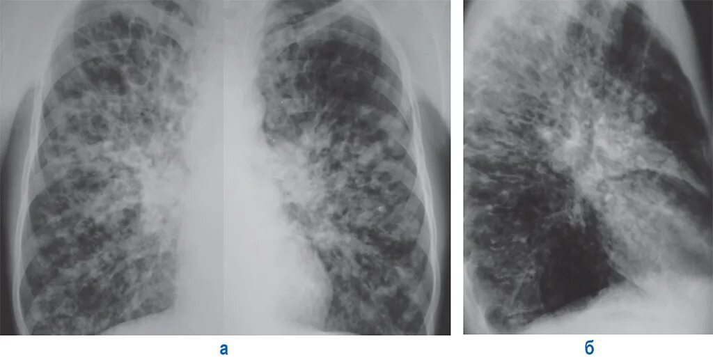 Кистозный фиброз легких рентген. Муковисцидоз легочная форма у детей рентген. Легочный фиброз на рентгене. Легкие фиброзного характера
