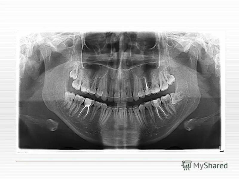 Снимок зубов видное. Ортопантомограмма пародонтит. Ортопантомограмма перелом челюсти.