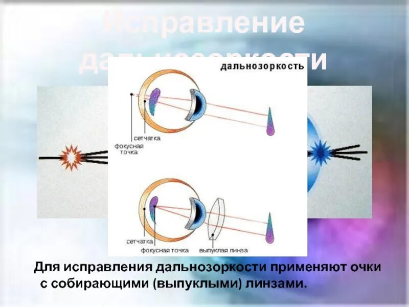 Операция при дальнозоркости