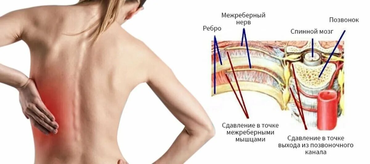 Межреберная невралгия со стороны спины симптомы