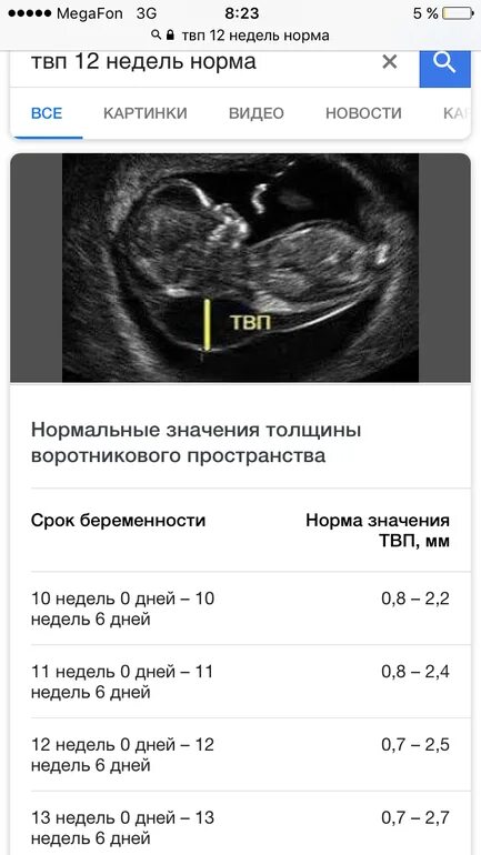 ТВП В 13 недель норма таблица по УЗИ. Норма по УЗИ В 13 недель воротниковое пространство. Норма ТВП В 13 недель беременности таблица по УЗИ. Толщина воротникового пространства в 12 недель норма скрининг. Сколько будет 13 недель