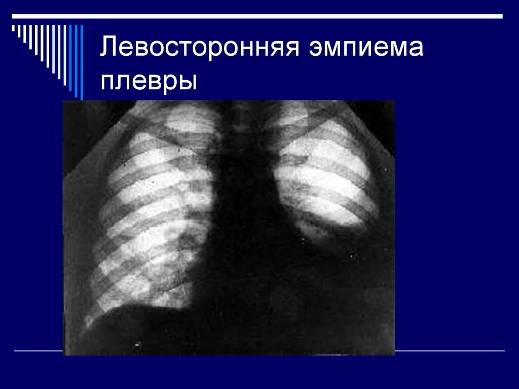 Эмпиема легкого. Хроническая эмпиема плевры рентген. Тотальная эмпиема плевры рентген. Эмпиема легкого рентген. Гнойный плеврит эмпиема плевры.