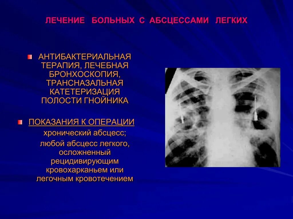 Абсцесс что означает в медицине. Абсцесс легкого показания к операции. абсцесс легкого терапия. стадии острого абсцесса легкого.