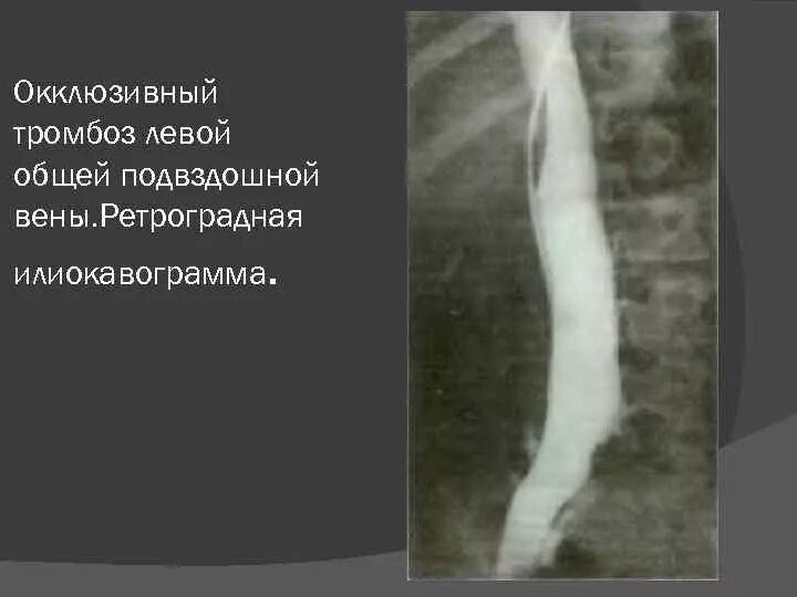 Подвздошный тромбоз симптомы. Неокклюзивный тромбоз глубоких вен. окклюзивный илеофеморальный тромбоз. илеофеморальный тромбоз глубоких вен. тромбоз подвздошной вены.