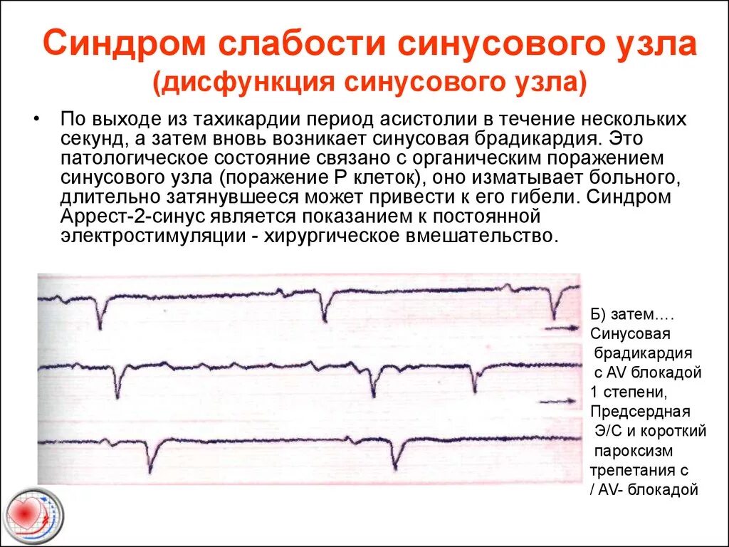 Дисфункция синусового узла что это. ЭКГ вегетативная дисфункция синусового узла. ЭКГ при синдроме слабости синусового узла. ЭКГ критерии дисфункции синусового узла. Синдром слабости синоатриального узла ЭКГ.