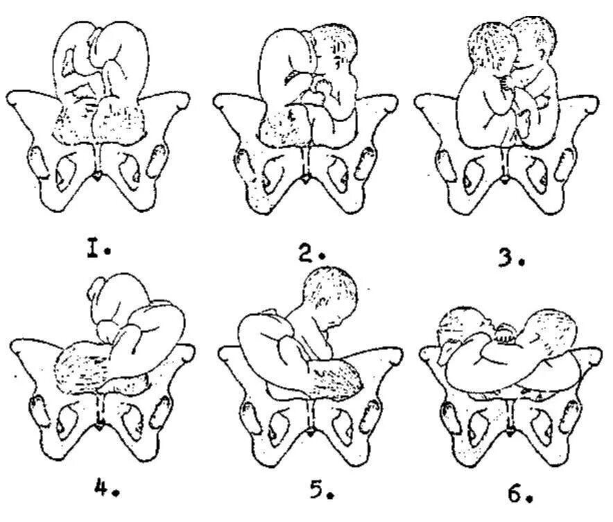Ребенок расположен справа. Ягодичное предлежание плода позиция 1. Тазовое предлежание 2 позиция. Ягодичное предлежание 2 позиция. Поперечное предлежание двойни.