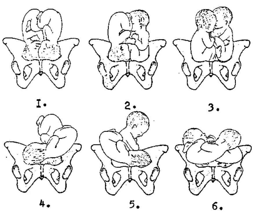 Правильное предлежание. Ягодичное предлежание плода позиция 1. Тазовое предлежание 2 позиция. Ягодичное предлежание 2 позиция. Поперечное предлежание двойни.