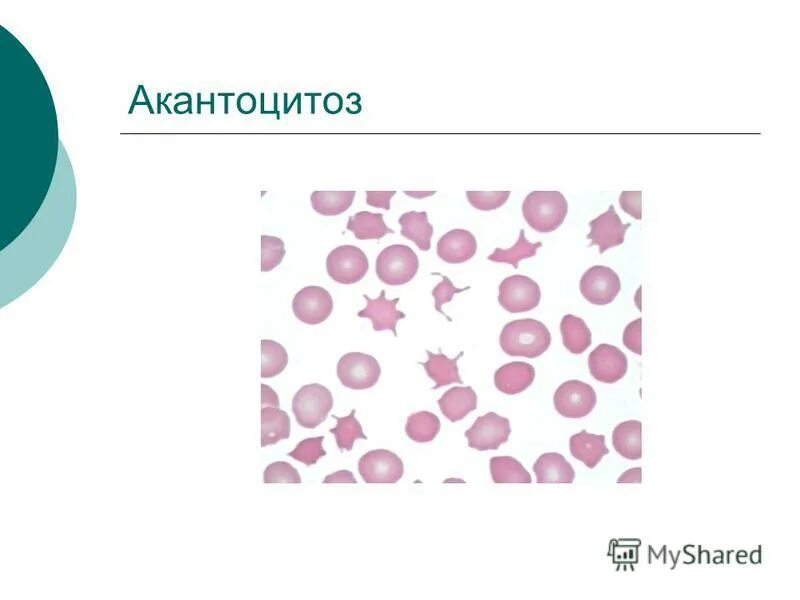 Наследственный акантоцитоз. Акантоциты в мазке крови. Шизоциты. Шизоциты в мазке крови. Эхиноциты