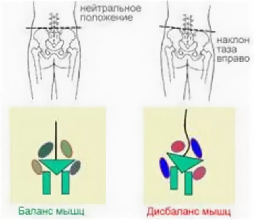 Как выровнять таз