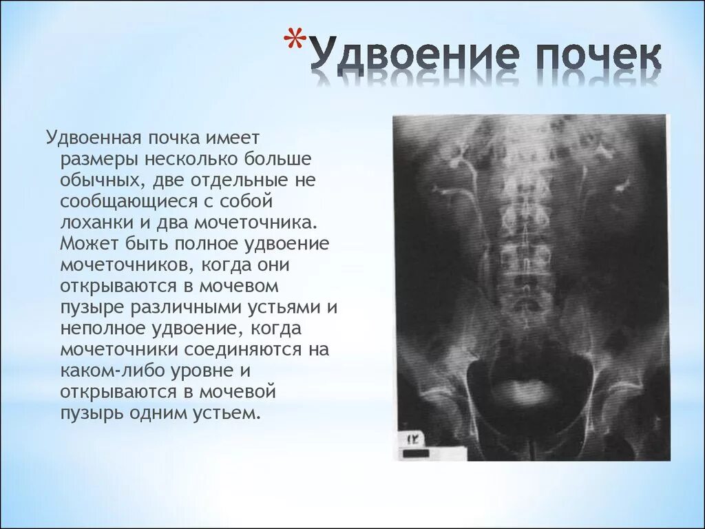 Диффузная почка что это значит. Неполное удвоение почки рентген. Удвоение чашечно-лоханочной системы почек. Неполное удвоение ЧЛС почки на рентгене. Удвоение почки экскреторная урография.