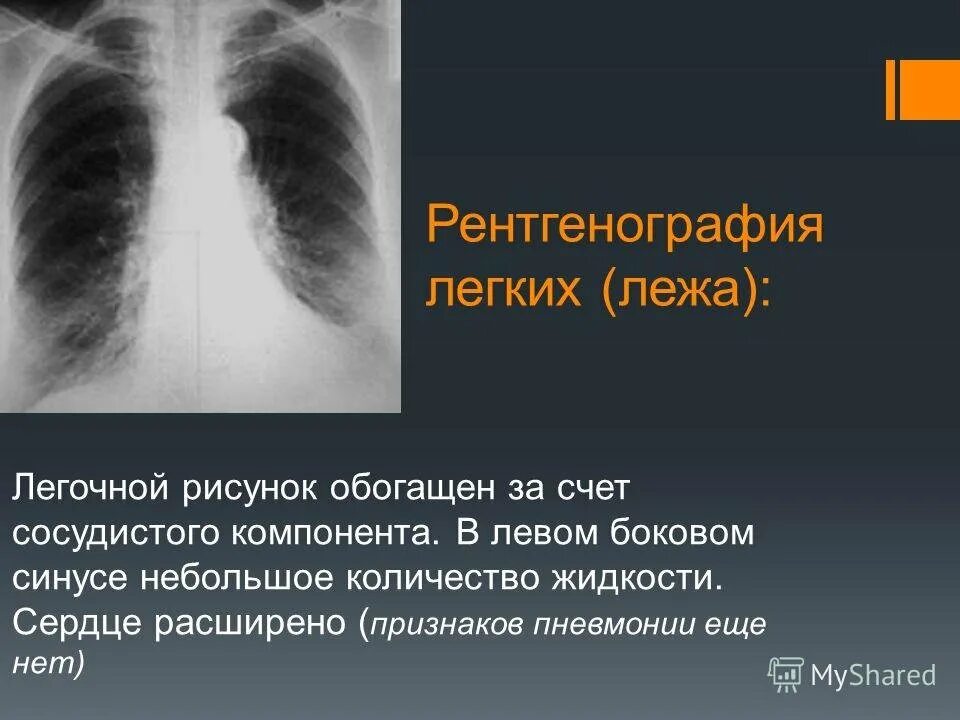 Легочный рисунок обогащен. Обогащение легочного рисунка. Легочной рисунок на рентгенограмме. Усиление легочного рисунка за счет сосудистого компонента.