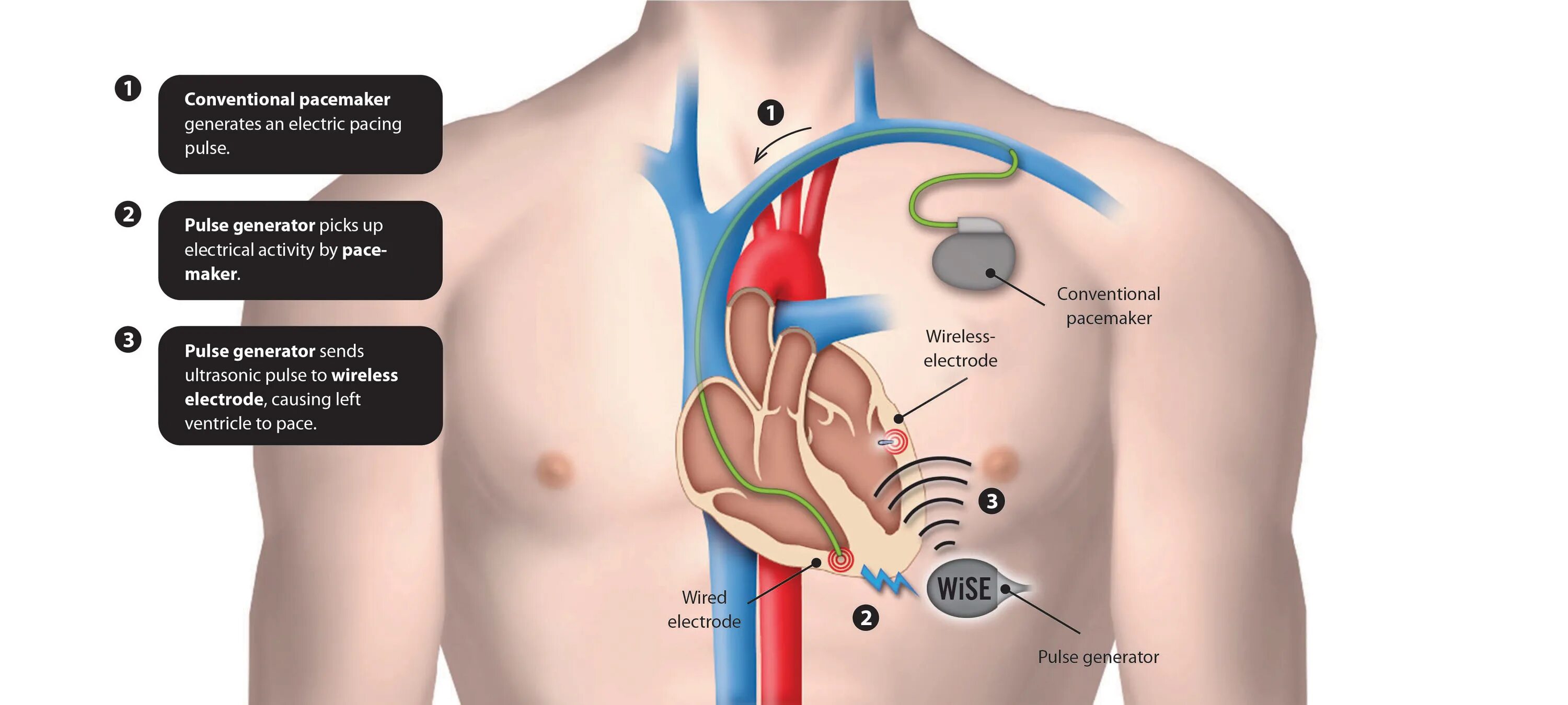 Если стоит кардиостимулятор можно. Искусственный стимулятор сердца. Двухкамерный кардиостимулятор. Однокамерный кардиостимулятор. Имплантируемый кардиостимулятор.