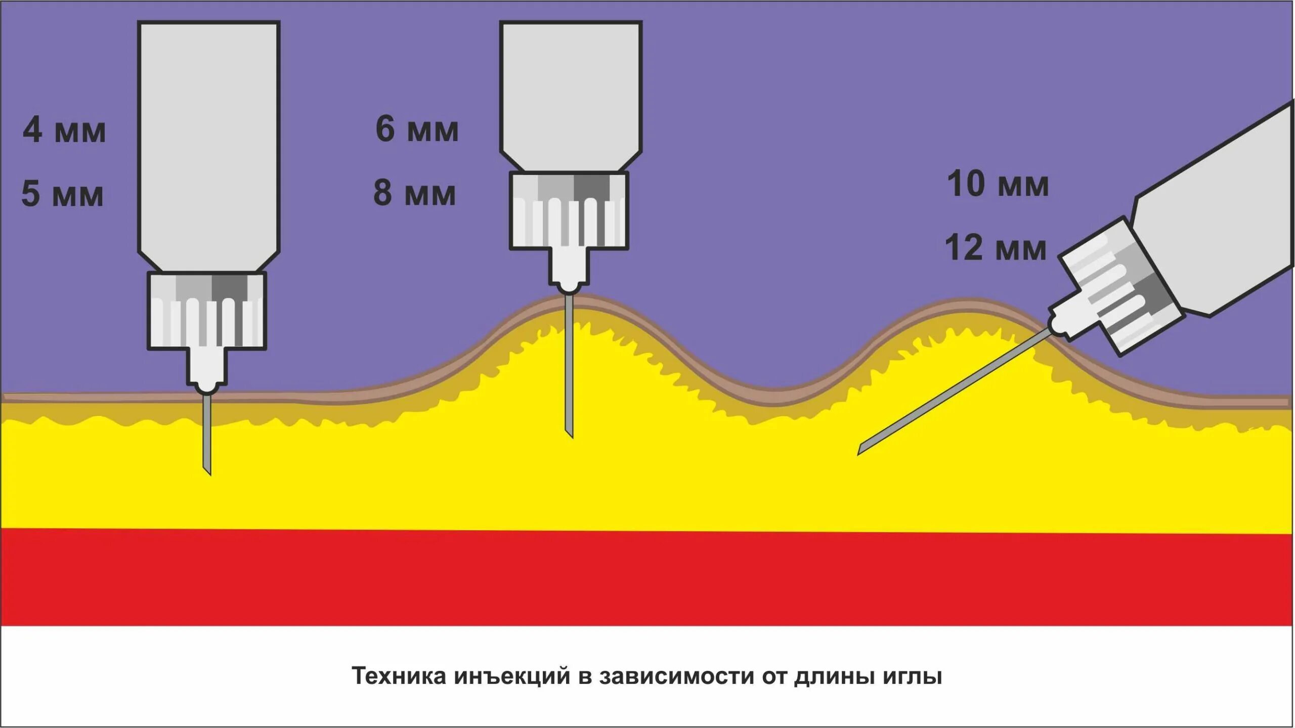 Внутрикожная игла длина. Техника подкожного введения инсулина шприцом. Введение инсулина подкожно шприц ручкой. Введение инсулина шприцом подкожно. Введение инсулина иглами различной длины.