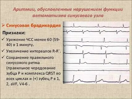 Нерегулярный сердца