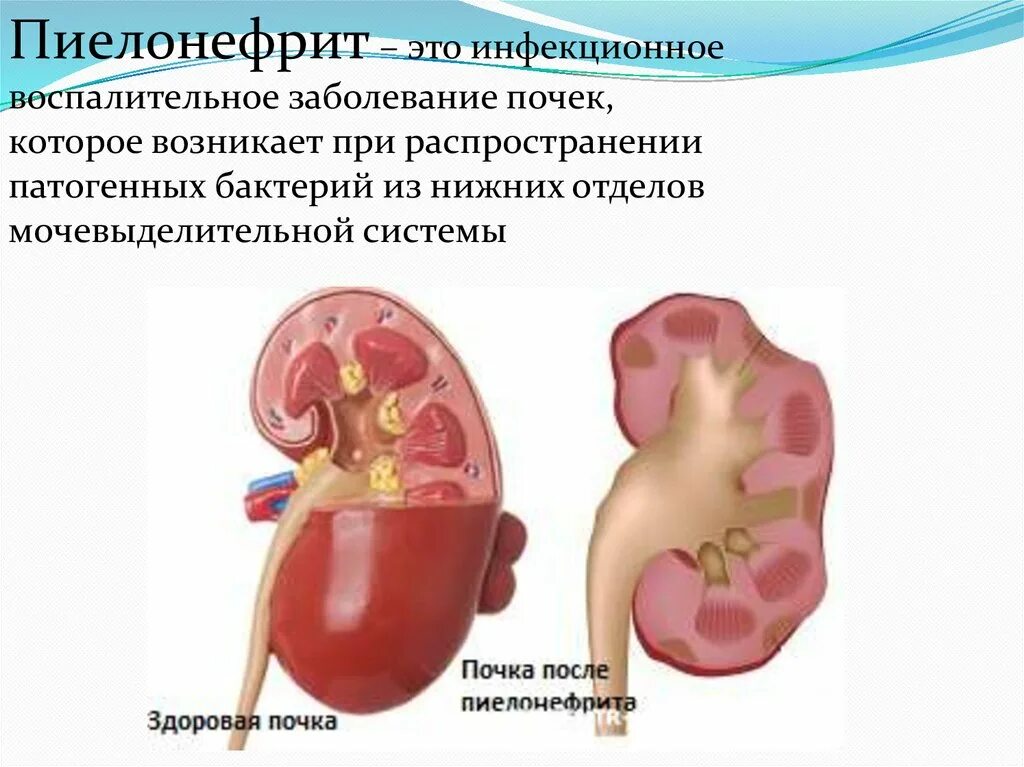 Пиелонефрит 2 степени гидронефроз. Гидронефроз левой почки 2ст. Пиелонефрит и гломерулонефрит. Гидронефроз почки осложнения. Осложнения на почки после