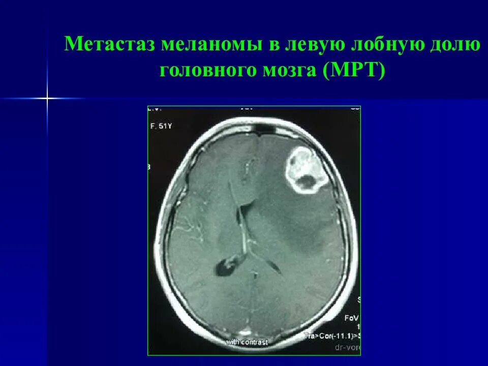 Меланома метастазы в мозг