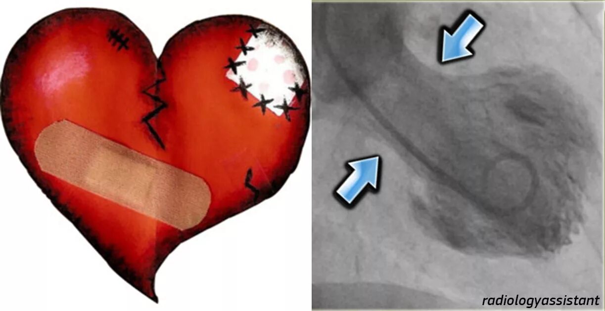 Синдром разбитого сердца. Признаки разбитого сердца. Кардиомиопатии такоцубо. Синдром безответной любви. Разбить сердце астерии
