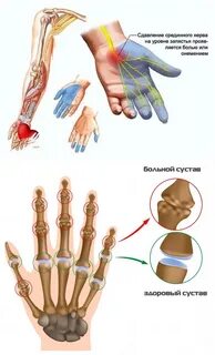 Почему болят пальцы на руках и ногах