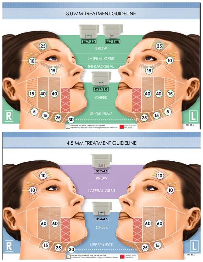 смас лифтинг протокол процедуры. разметка для смас лифтинга. ультразвуковой смас лифтинг hifu. Smas лифтинг ulthera. смас лифтинг линии сколько.