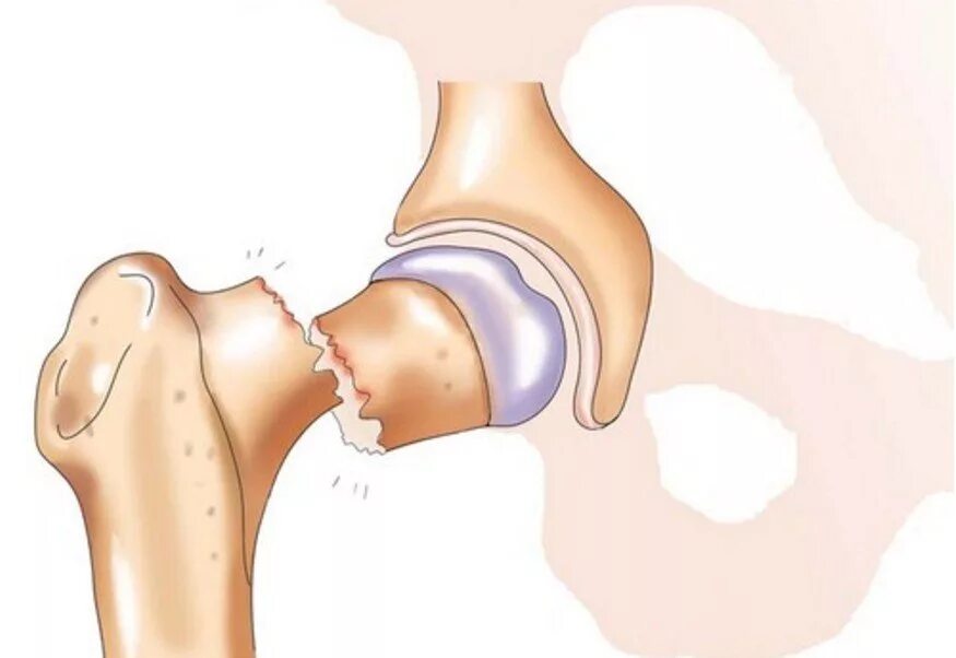 Симптомы шейка бедра у женщины. Тазобедренный сустав перелом шейки бедра. Открытый перелом шейки бедра. Вколоченный перелом тазобедренного сустава. Субтотальный перелом шейки бедра.