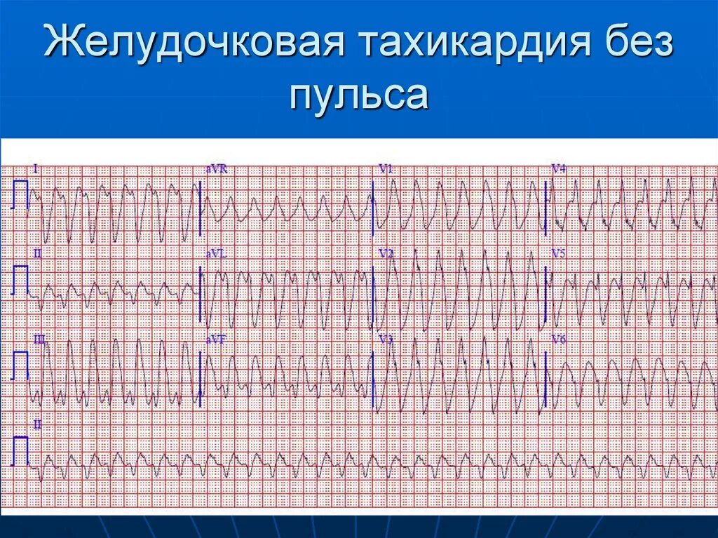 Желудочковая тахикардия на экг. Желудочковая тахикардия без пульса. Желудочковая тахикардия без пульса на ЭКГ. ЭКГ при желудочковой тахикардии без пульса. Желудочковая тахикардия.