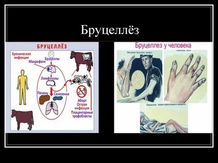 Бруцеллез что