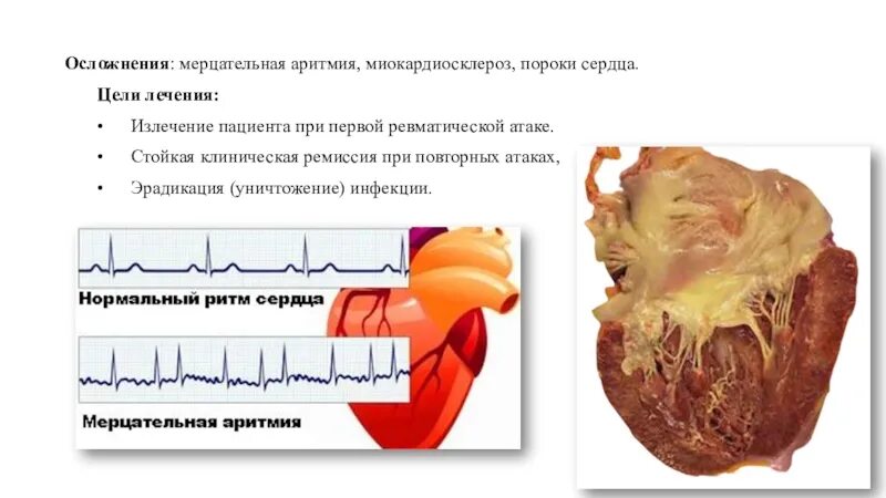 Аритмия последствия