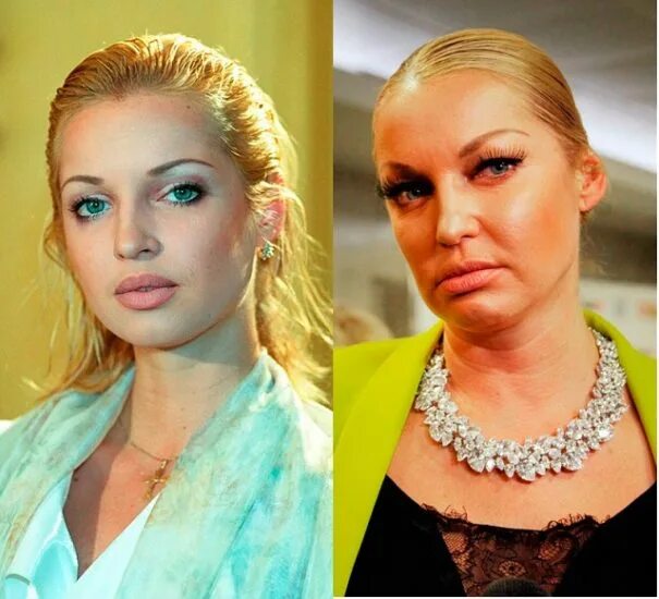 Какую пластику делать