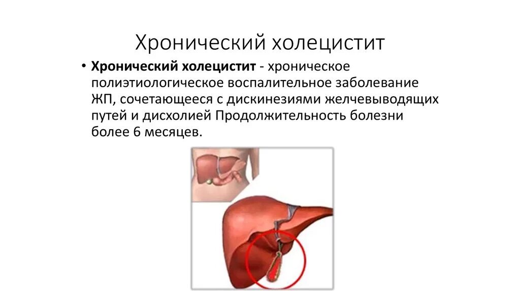 Хронический холецистит что это такое простыми словами. Асептический холецистит. Хронический холецистит с джвп. Хронический некалькулезный холецистит. Клинические симптомы хронического холецистита.